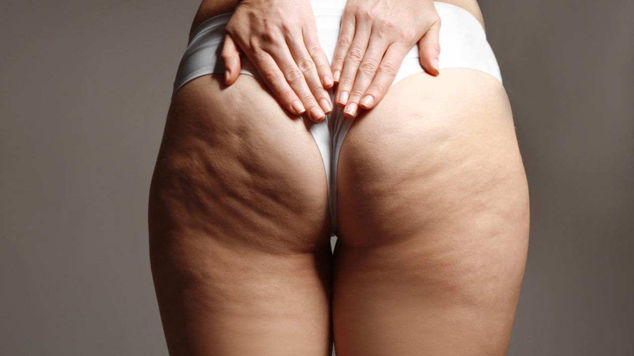 cellulite